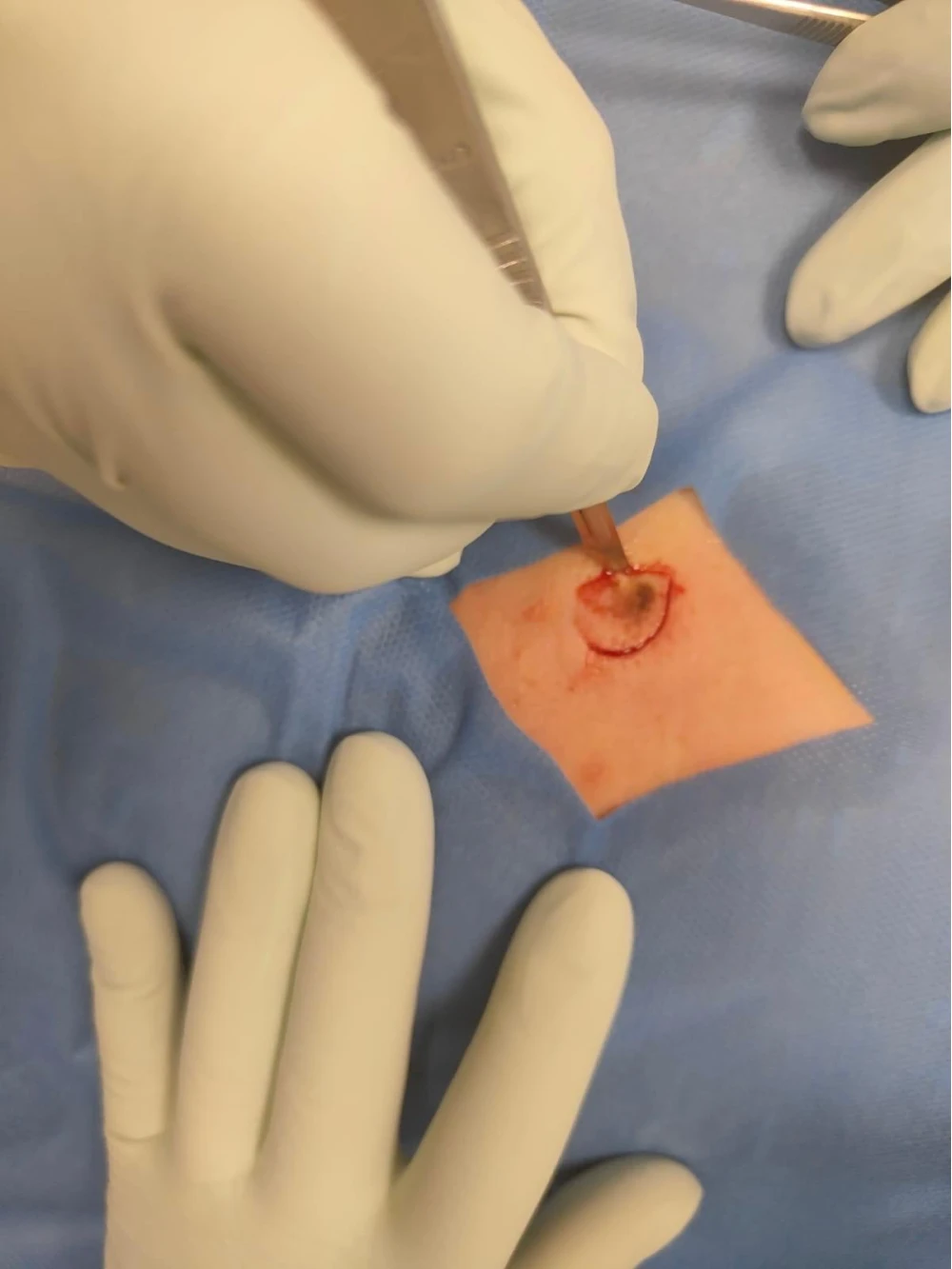 Excizii chirurgicale